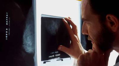 Vall d’Hebron identifica una proteïna clau per evitar la metàstasi del càncer de mama. (social.cat / AMIC)